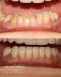 Before and after veneers result at Skhva Clinic – smile makeover with natural-looking teeth
