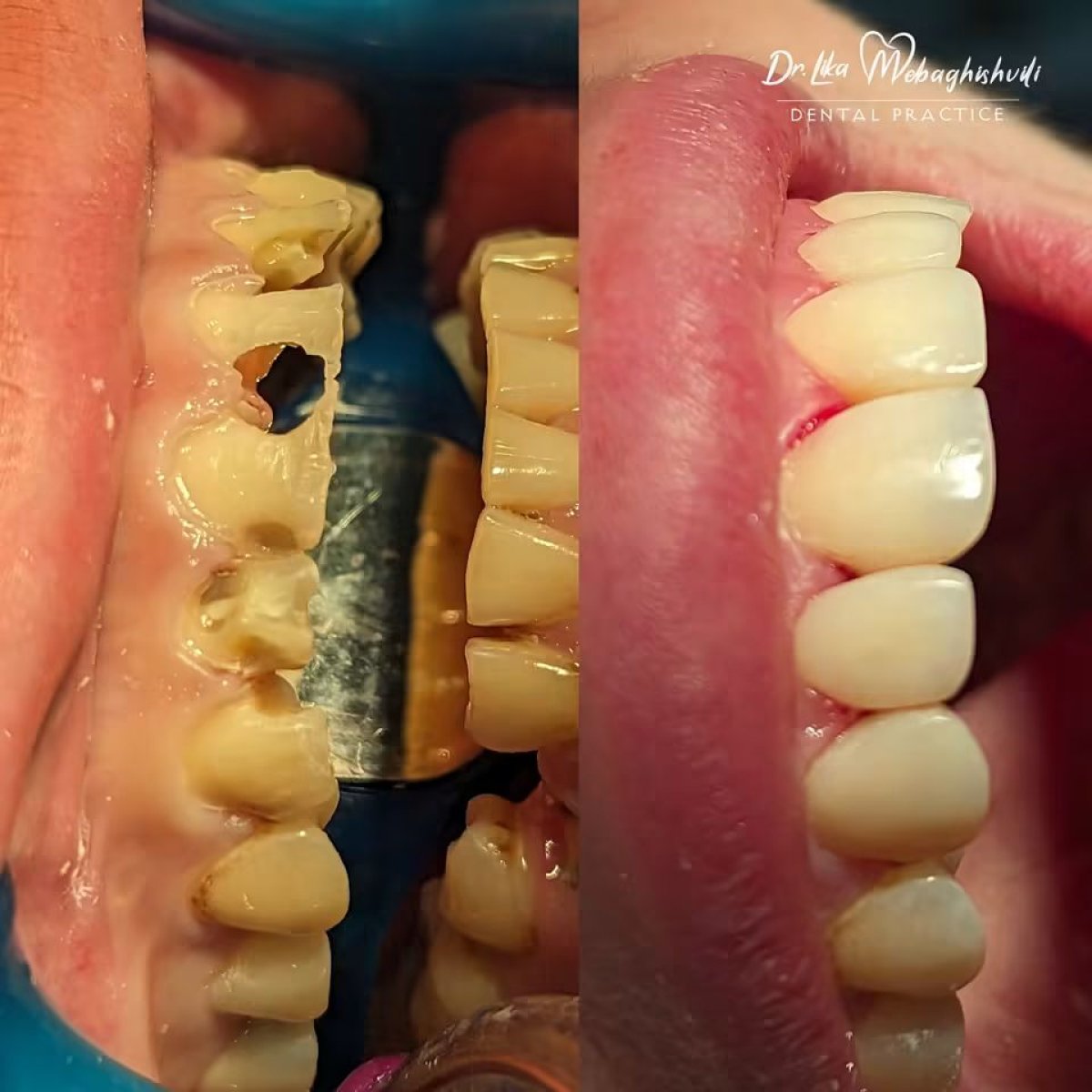 نتائج قبل وبعد حشو تجميلي مركب في عيادة Dr. Ika Mebaghishvili للأسنان