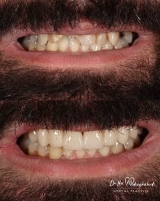 Porcelain veneer before and after results at Dr. Ilka Mebagishvili Dental Practice, smile makeover