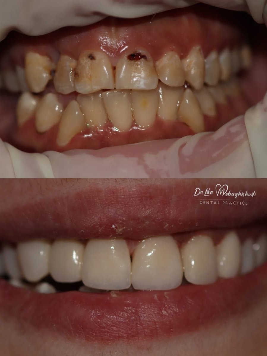 Resultados antes y después de relleno estético compuesto en Dr. Ika Mebagishvili Dental Practice