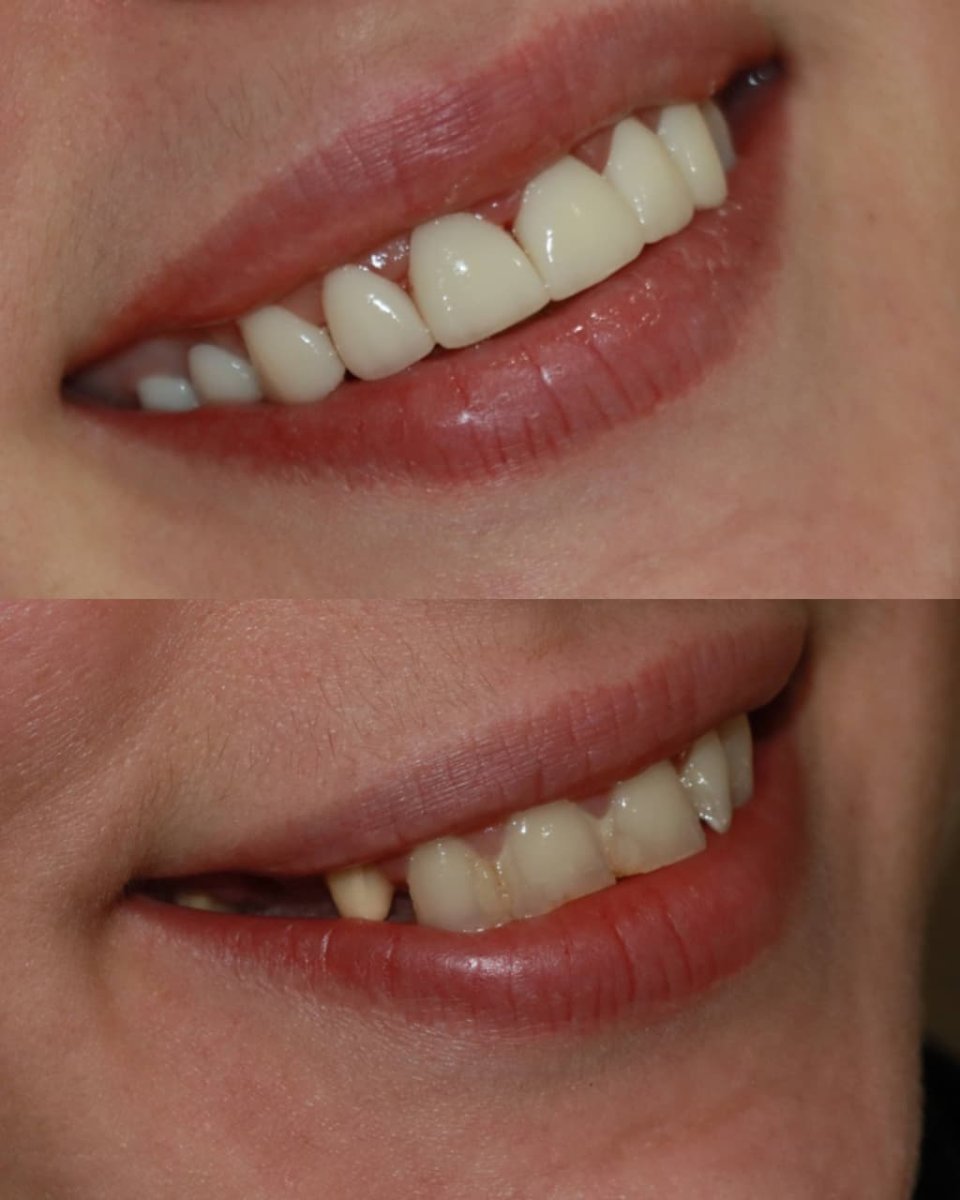 Resultado antes y después de carillas de zirconio: transformación de la sonrisa