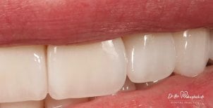 Emax veneers result at Dr. Ilka Mebagishvili Dental Practice – natural smile transformation