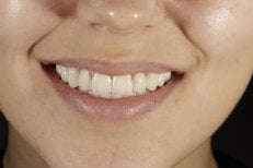 Smile transformation result with zirconia veneers, natural white teeth after procedure