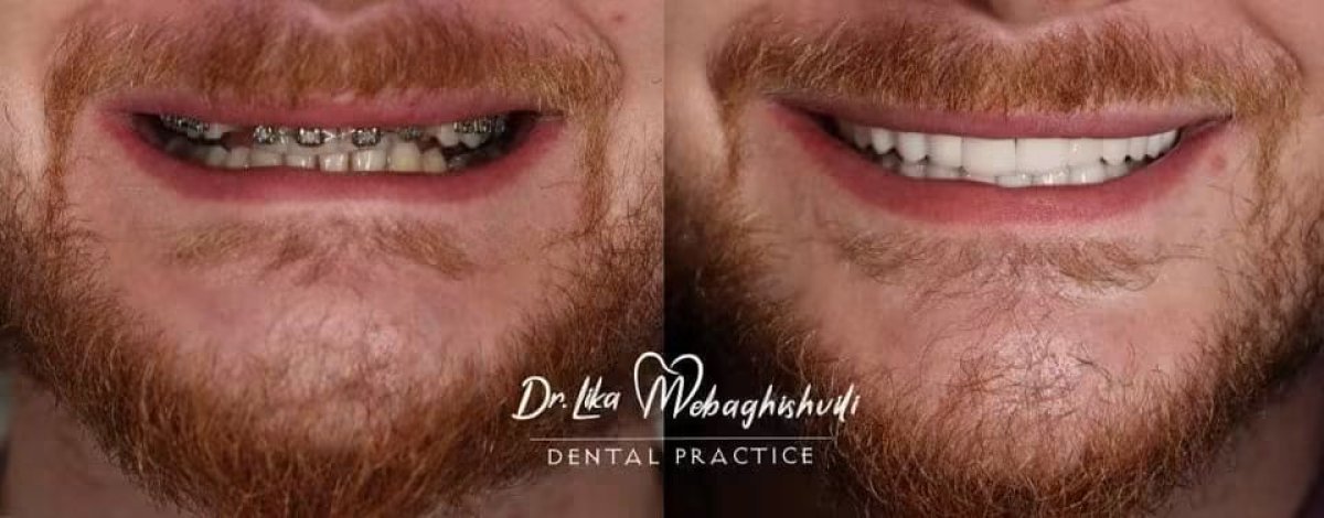 نتيجة قبل وبعد الفينير في عيادة Dr. Lika Mebaghishvili، تحول الابتسامة