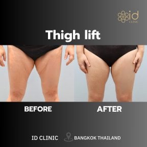Before and after thigh lift results at ID Clinic Bangkok, improved thigh contour and firmness