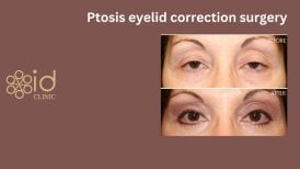 Before and after ptosis eyelid correction surgery results at ID Clinic Bangkok, improved eyelids