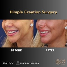 Результати до і після створення ямочок на щоках в ID Clinic Bangkok, виразні ямочки