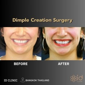 Результати до і після створення ямочок у ID Clinic Bangkok, покращені ямочки на щоках