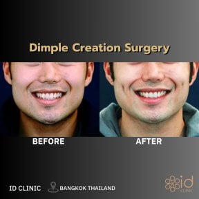 Результати до та після створення ямочок у ID Clinic Bangkok, покращені ямочки на щоках