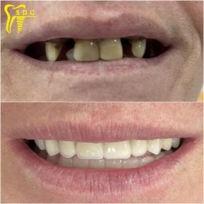 Результаты до и после имплантации зубов в Spanderashvili Dental Clinic, восстановленная улыбка