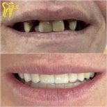 Результаты до и после имплантации зубов в Spanderashvili Dental Clinic, восстановленная улыбка