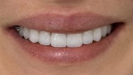 Résultat de pose de couronnes zircone à la clinique Spanderashvili – sourire blanc naturel