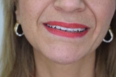 Zdjęcia przed i po Montaż korony cyrkonowej wykonane przez dr.