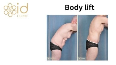before-after photo body-lift