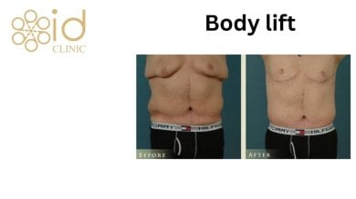 before-after photo body-lift
