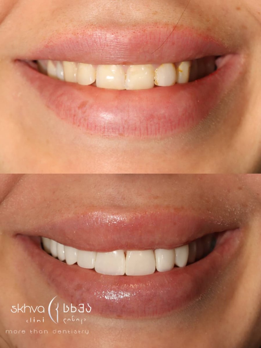Resultados de implantes dentales antes y después en Skhva Clinic – sonrisa mejorada y dientes blancos