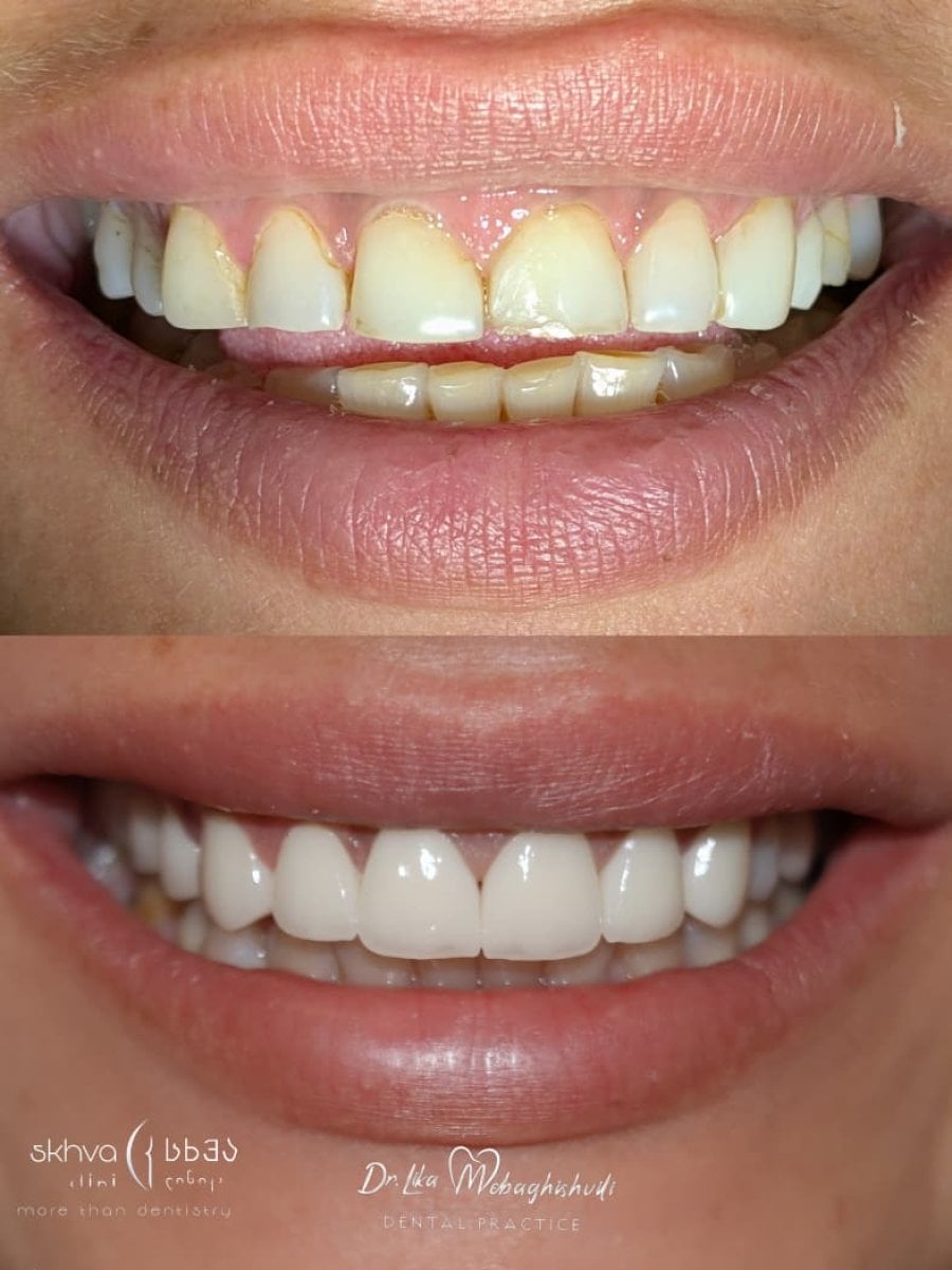 Antes y después de carillas dentales en clínica Skhva Abash – resultados de sonrisa