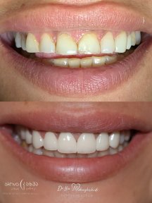 Vorher-nachher Veneers bei Skhva Abash Klinik – Ergebnis des Smile Makeovers