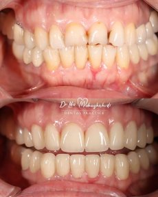 Vorher-nachher-Ergebnisse Zahnimplantat bei Dr. Lika Mebaghishvili Dental Practice, Lächelrestauration