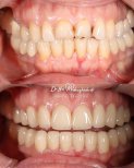 Vorher-nachher-Ergebnisse Zahnimplantat bei Dr. Lika Mebaghishvili Dental Practice, Lächelrestauration