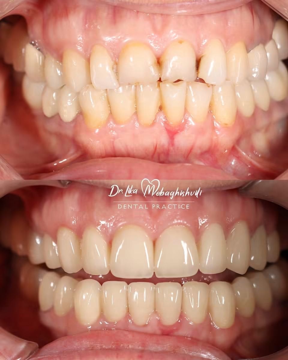 Resultados de sonrisa antes y después en Dr. Lika Mebaghishvili Dental Practice, carillas