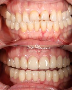 Resultados de sonrisa antes y después en Dr. Lika Mebaghishvili Dental Practice, carillas