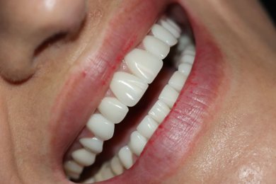 Resultado de cambio de sonrisa con carillas dentales: dientes más blancos y uniformes