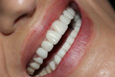 Resultado de cambio de sonrisa con carillas dentales: dientes más blancos y uniformes