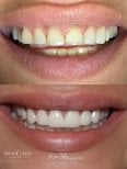 Resultados de antes y después de carillas dentales en Skhvababa Clinic