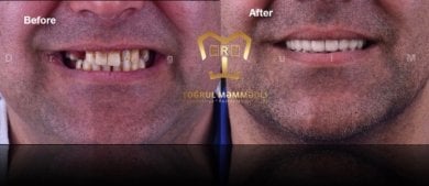 before-after photo all-on-6-dental-implants