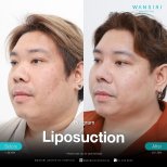 Résultats avant/après liposuccion du menton à Wansiri Hospital, amélioration du menton