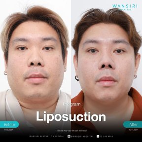 Résultats avant/après liposuccion du menton à Wansiri Hospital, amélioration du contour facial