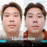 Résultats avant/après liposuccion du menton à Wansiri Hospital, amélioration du contour facial