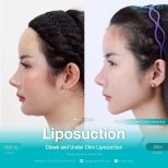 Résultats avant/après liposuccion du menton à Wansiri Hospital, contour de mâchoire affiné