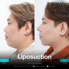 Résultats avant/après liposuccion du menton à Wansiri Hospital, contour amélioré