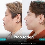 Résultats avant/après liposuccion du menton à Wansiri Hospital, contour amélioré