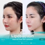 Résultats avant/après liposuccion du menton à Wansiri Hospital, contour de mâchoire affiné