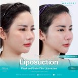 Résultats avant/après liposuccion du menton à Wansiri Hospital, contour amélioré