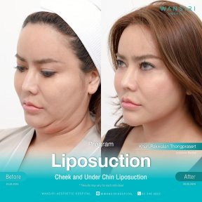 Résultats avant/après liposuccion du menton à Wansiri Hospital, contour amélioré