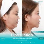 Résultats avant/après liposuccion du menton à Wansiri Hospital – contour amélioré