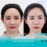 Résultats avant-après liposuccion du menton à Wansiri Hospital, contour amélioré