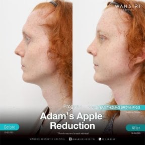 Antes y después de reducción de nuez de Adán en Wansiri Hospital – mejora visible del cuello