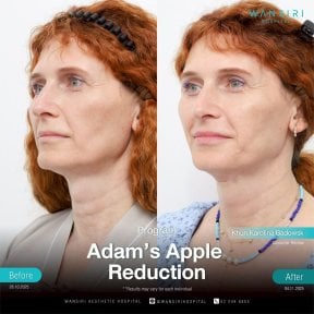 Antes y después de reducción de nuez de Adán en Wansiri Hospital – contorno de cuello visible