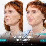 Antes y después de reducción de nuez de Adán en Wansiri Hospital – contorno de cuello visible