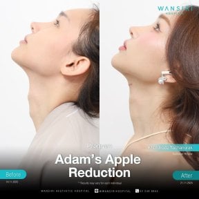 Antes y después de reducción de nuez en Wansiri Hospital – contorno de cuello visible