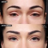 Before and after Fox Eye Lift results at VG Plastic Surgery – lifted, rejuvenated eye appearance
