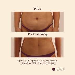 Resultados de abdominoplastia y liposucción antes y después en InSense Clinic (SV Plastic Surgery Clinic)