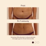 Resultados de abdominoplastia y liposucción antes y después en InSense Clinic (SV Plastic Surgery Clinic)