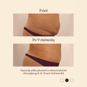 Resultados de abdominoplastia y liposucción en InSense Clinic, 9 meses después