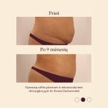 Resultados de abdominoplastia y liposucción en InSense Clinic, 9 meses después